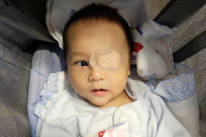 Leczenie zeza u niemowląt – maluszek z zasłoniętym jednym okiem