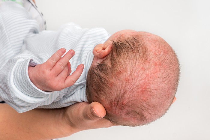 atopic dermatitis in infants