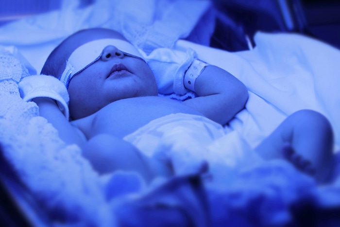 babies with zcouetaczkae during phototherapy