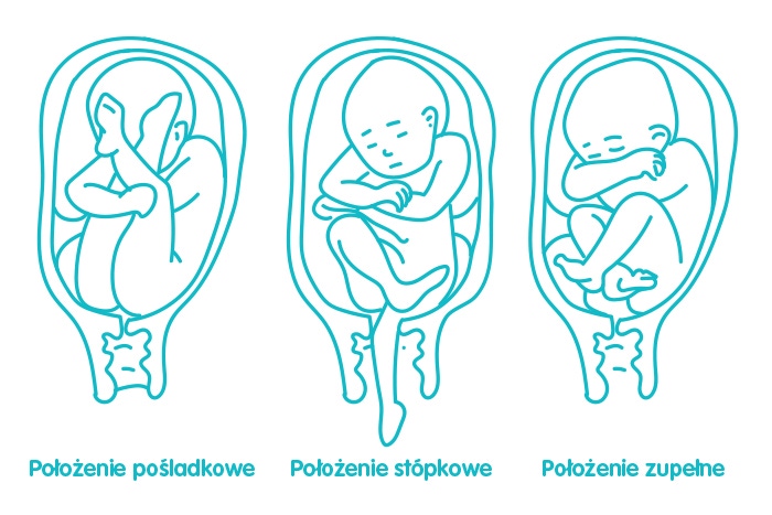 complete post-buttock position