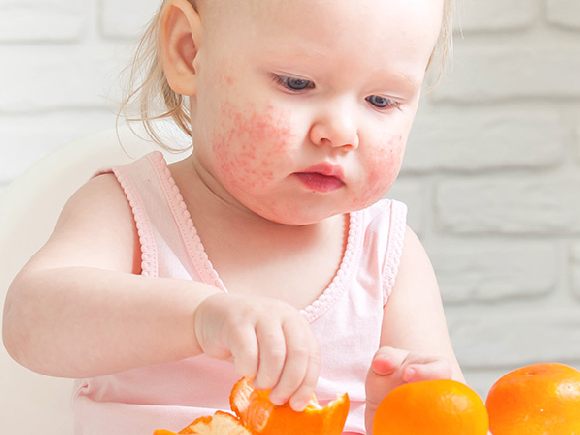 Dziewczynka z alergią pokarmową po zjedzeniu uczulającego produktu