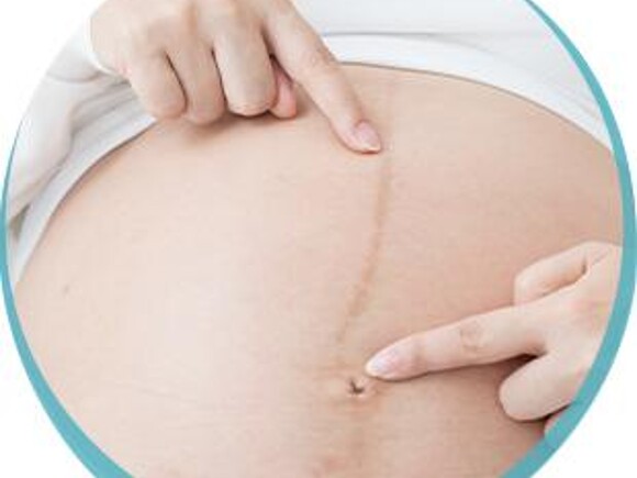 Brzuch w ciąży – linea negra