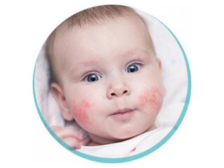 alergia pokarmowa dziecko