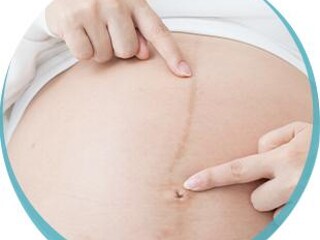 Brzuch w ciąży – linea negra