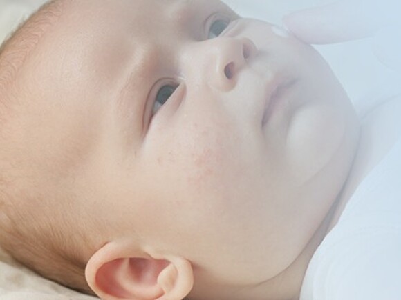 Objawy alergii u niemowląt – dziecko z wysypką na buzi