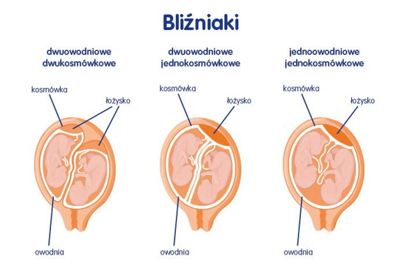 Bliźniaki jednojajowe - rodzaje Bliźniaki jednojajowe - rodzaje
