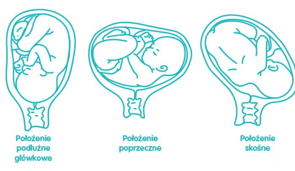 Infografika przedstawia wersje ułożenia ciała dziecka w ciąży