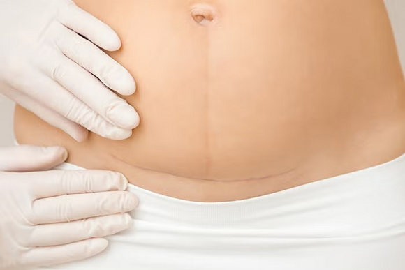 Fizjoterapeuta uroginekologiczny sprawdza bliznę po cesarskim cięciu Fizjoterapeuta uroginekologiczny sprawdza bliznę po cesarskim cięciu