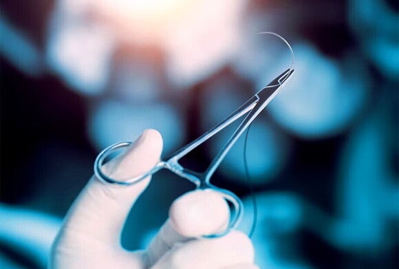 Nacięcie krocza i jego zszywanie