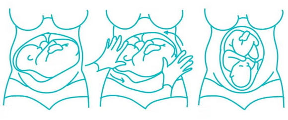 Infografika przedstawia wersje położenia miednicowego ciała dziecka