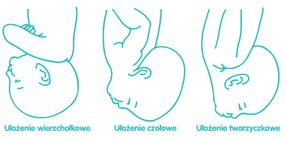 Infografika przedstawia wersje ułożenia głowy dziecka w ciąży